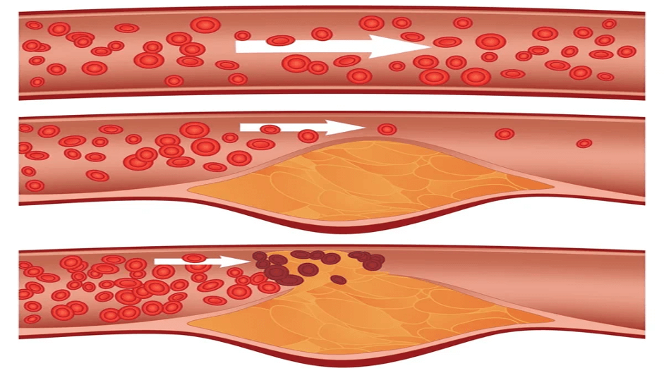 blood hypertension