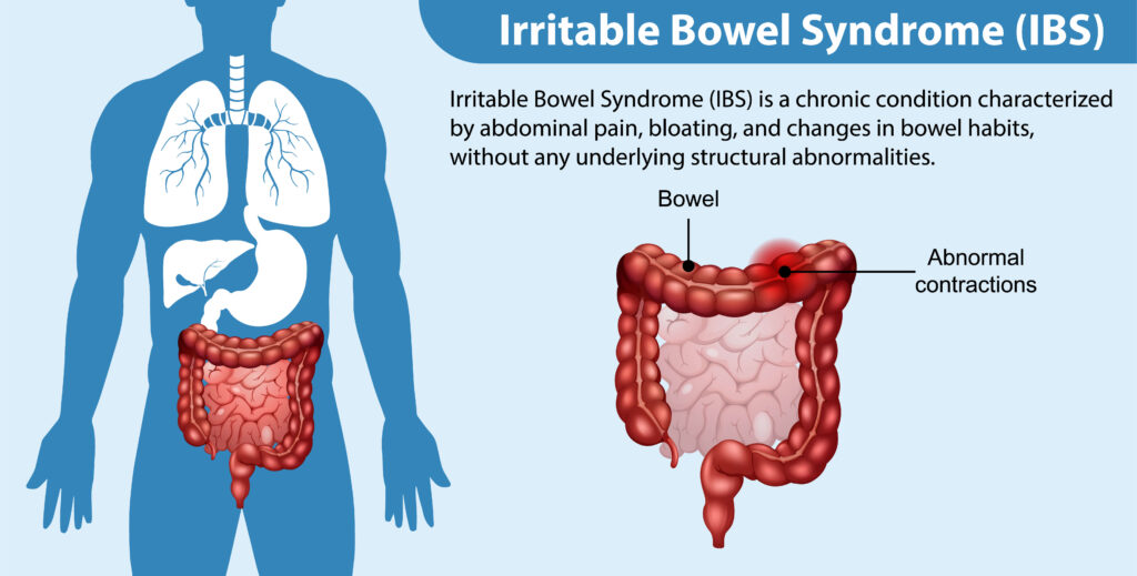 IBS irritable bowel syndrom infographic