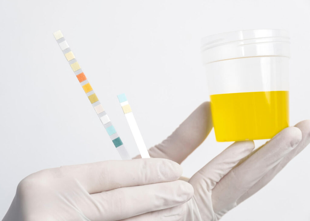 cystine crystals in urine | concentrated urine
