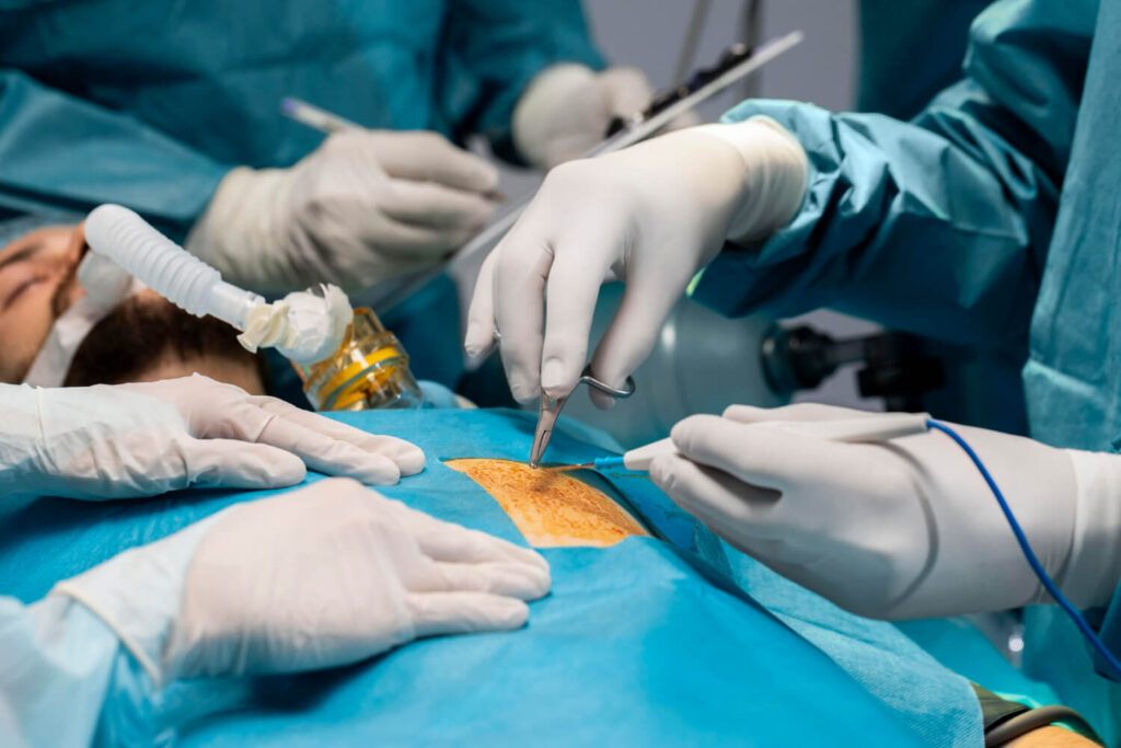 kidney stone removal | surgical approach