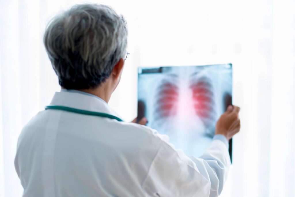 chest x-ray to diagnose asthma cough
