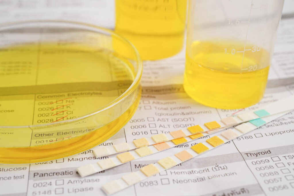 urine test for urinary tract infection