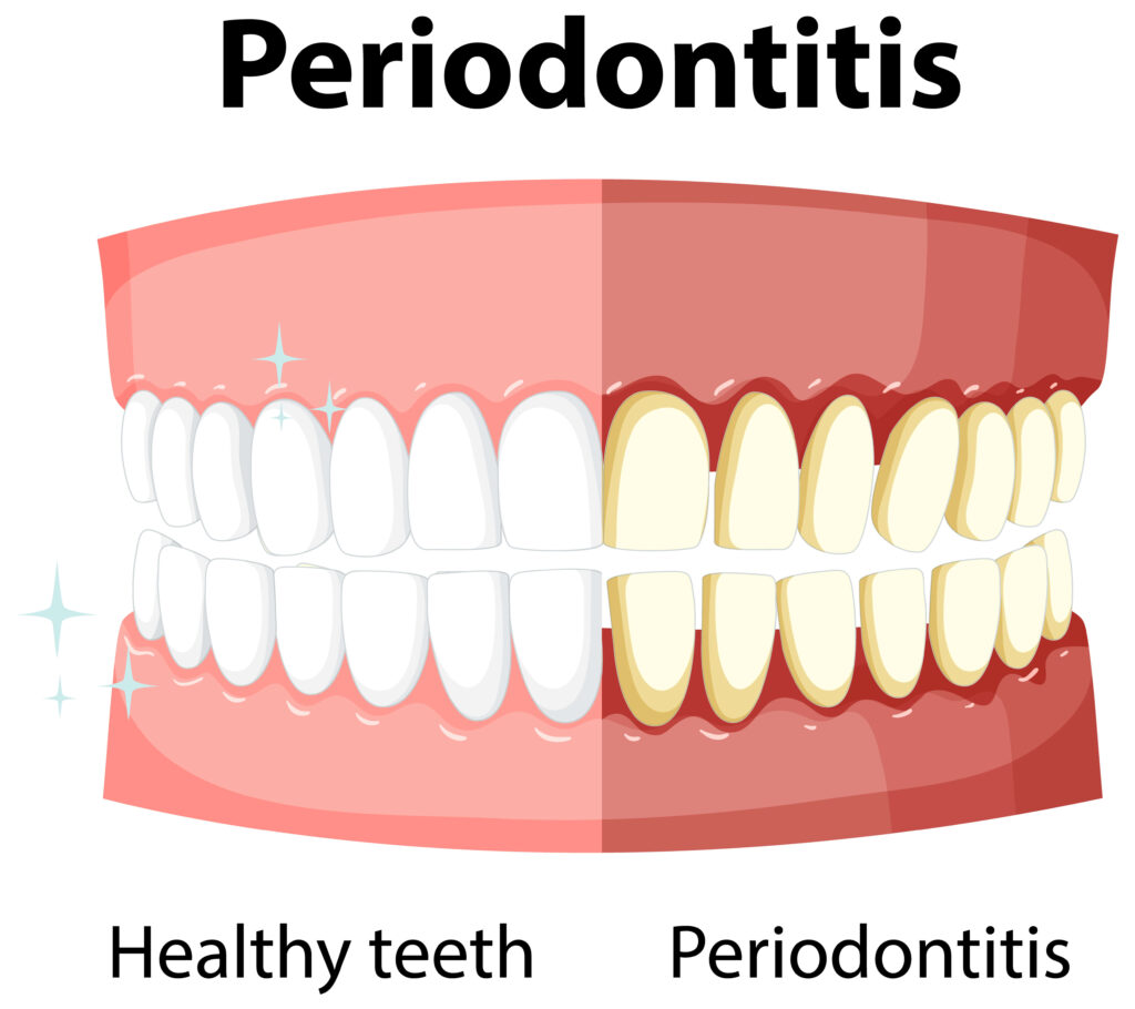 periodontitis