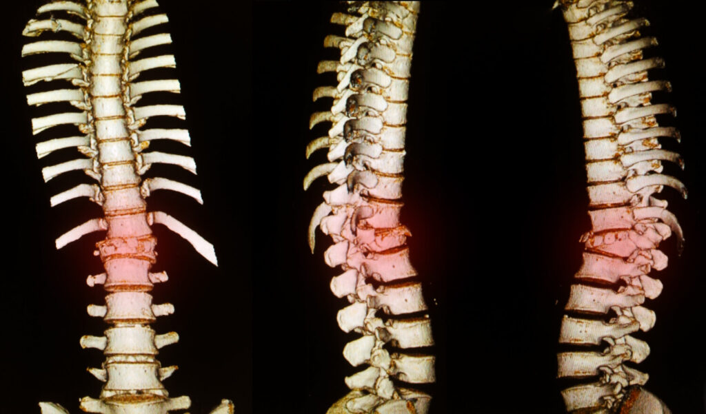 vertebral fractures - osteoporosis