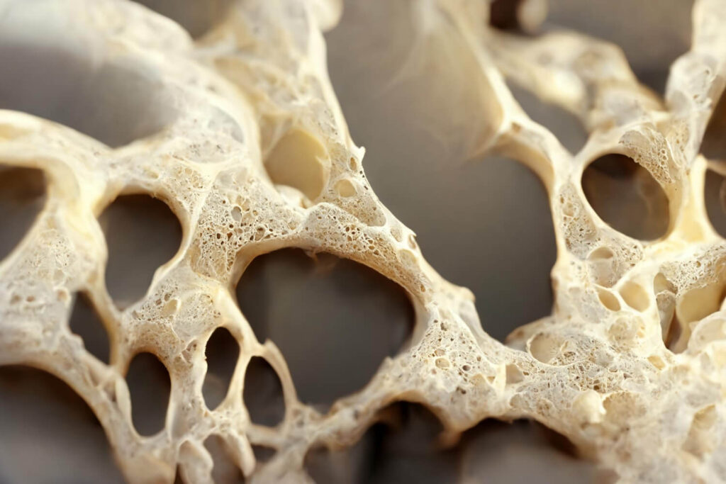 how osteoporosis affects the bone health