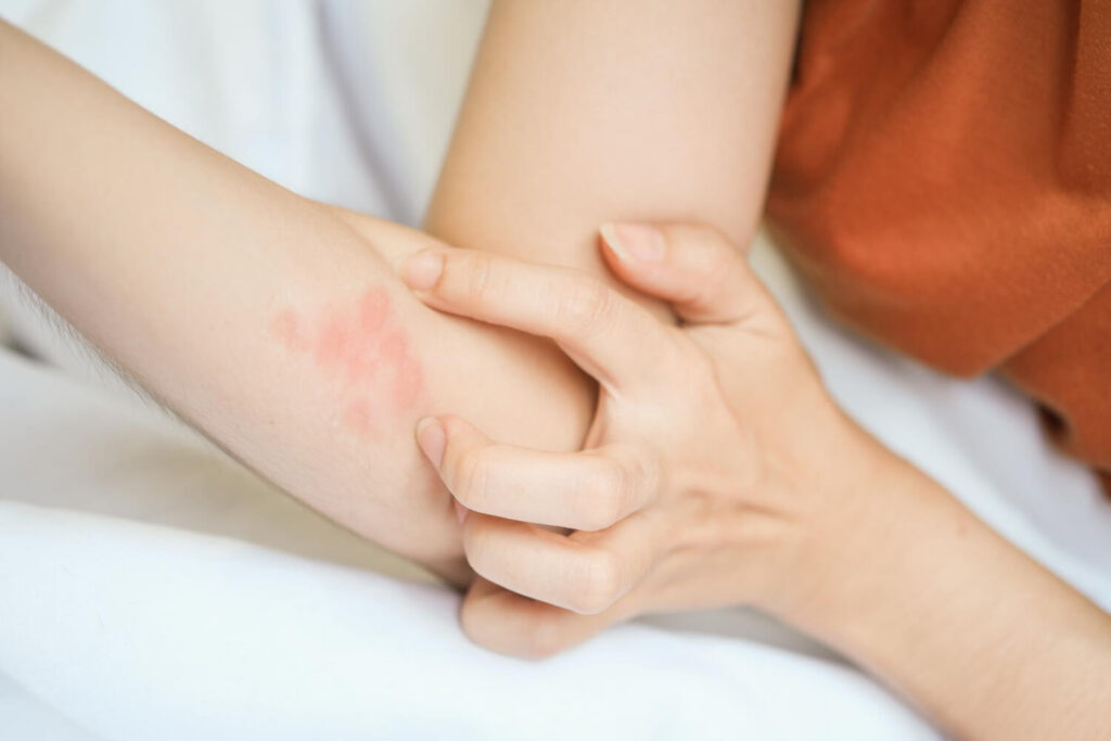 rashes - strep infection symptom