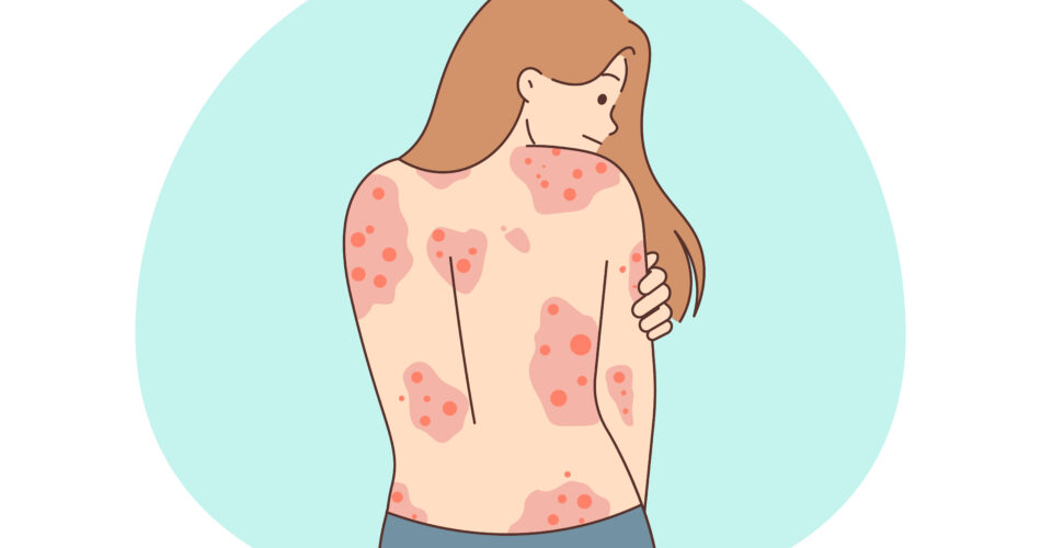 atopic dermatitis