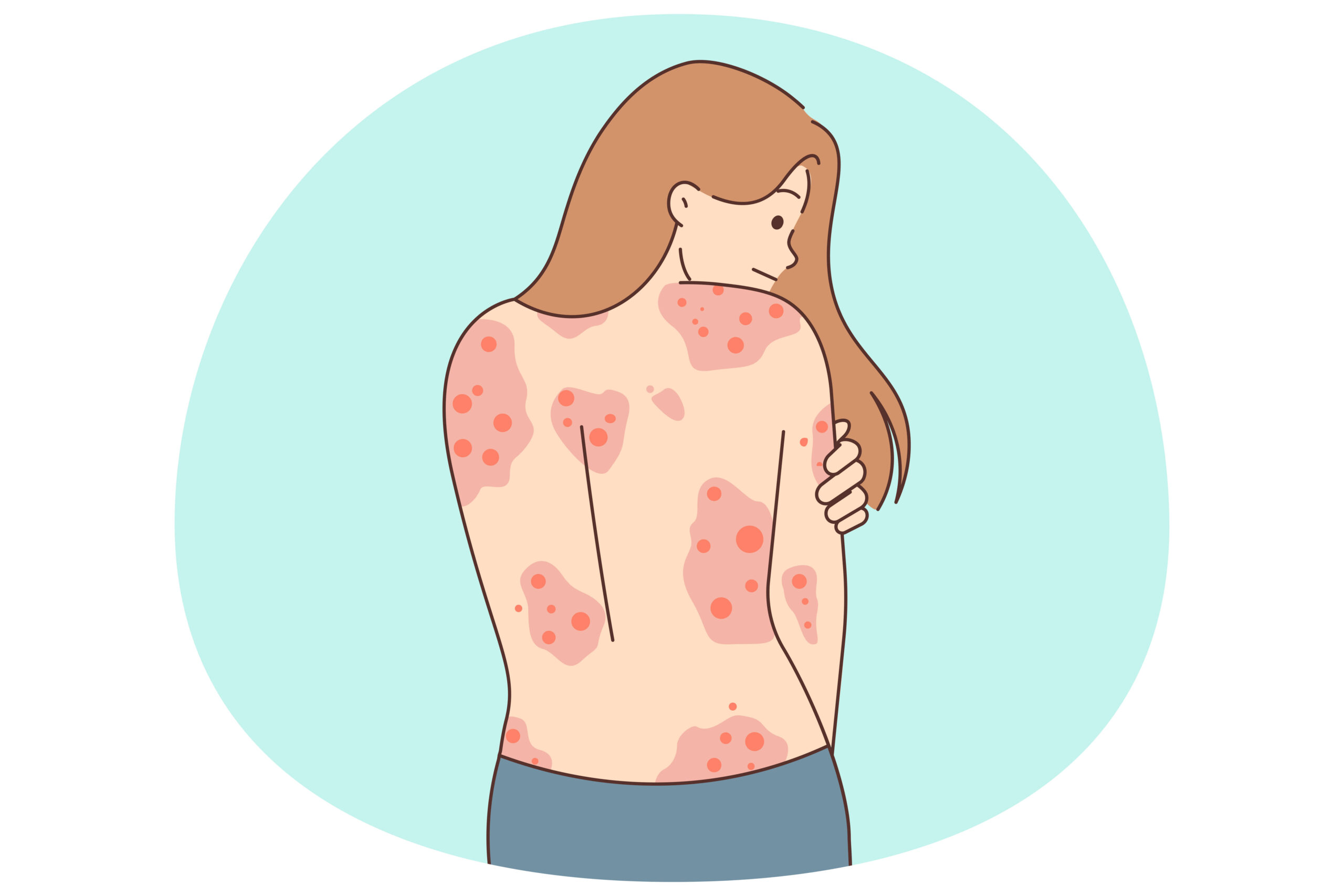 Expert Guide: Atopic Dermatitis Symptoms & Treatments