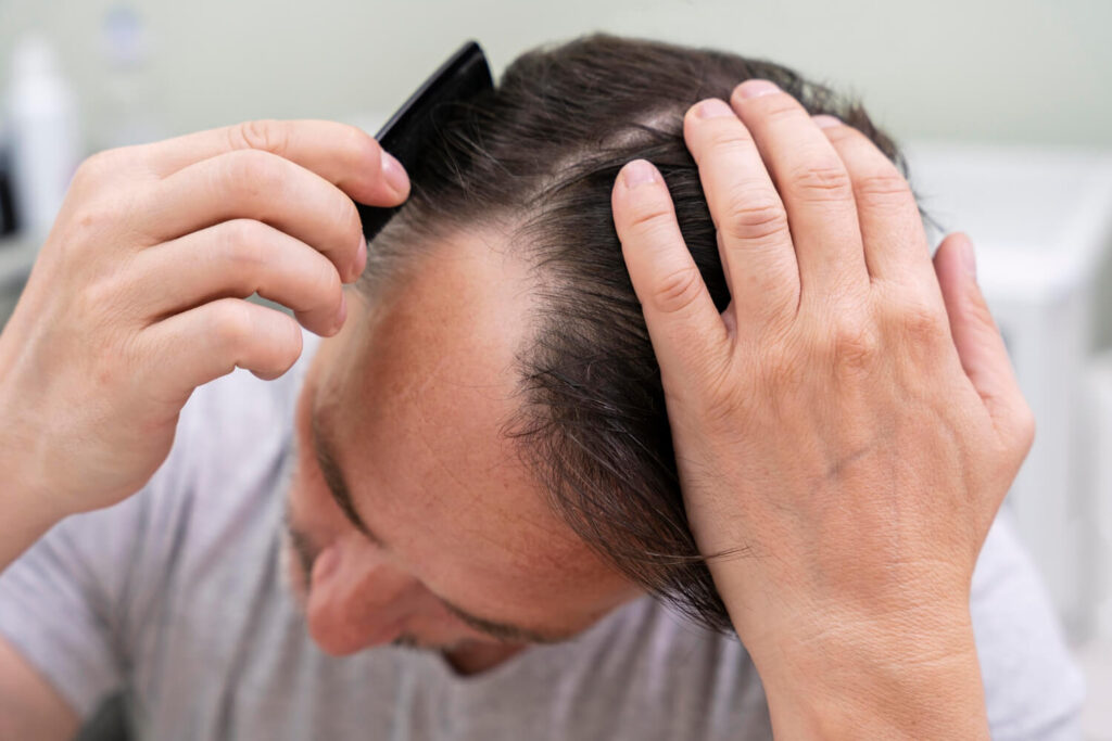 hair loss causes - male pattern baldness