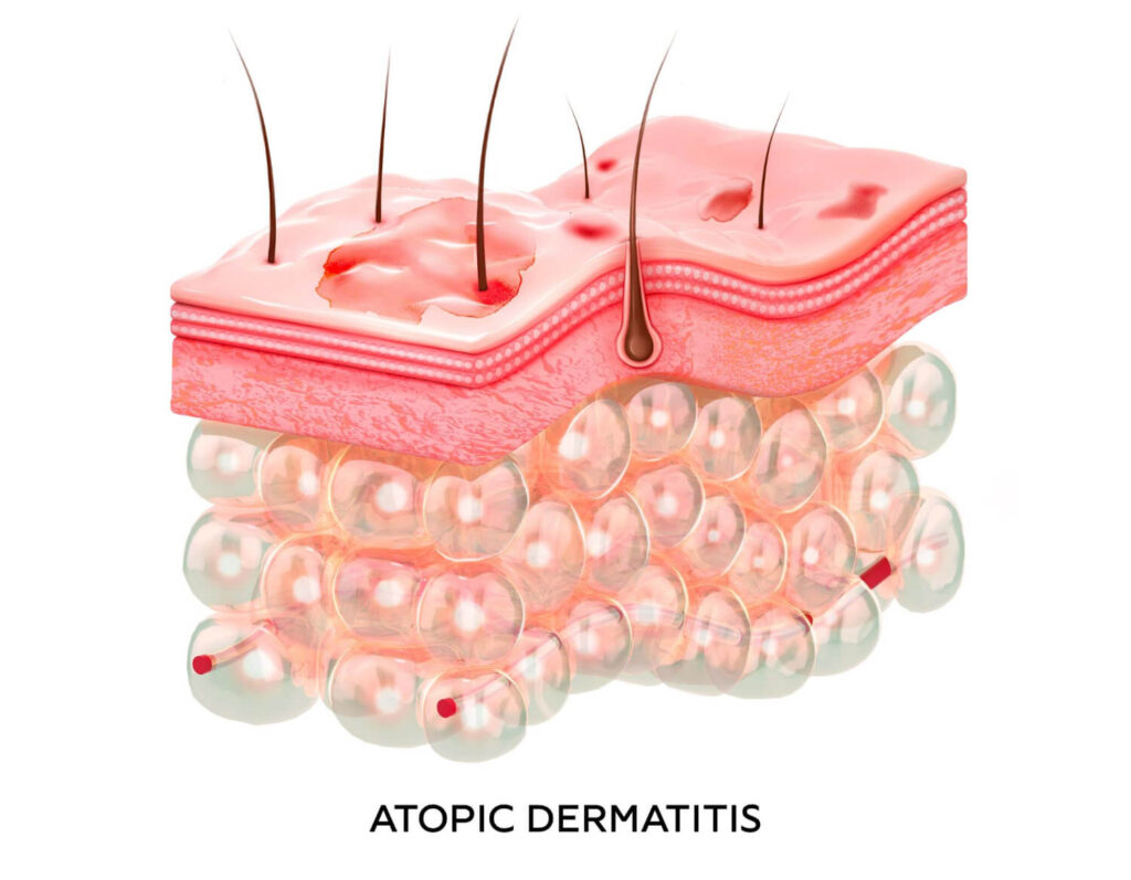 infographic of atopic dermatitis