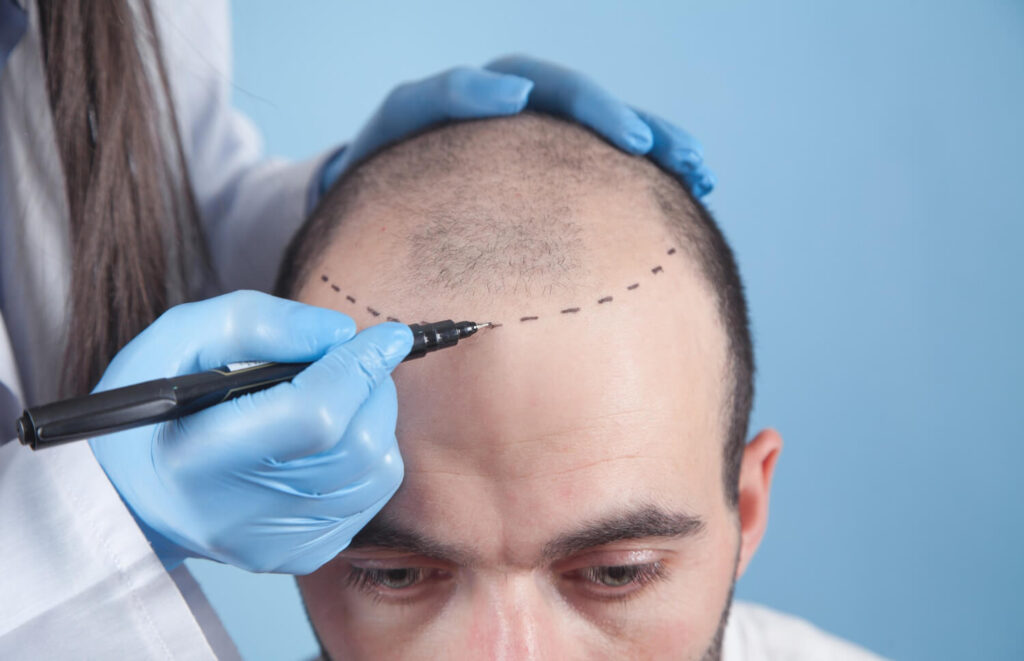 managing hair loss causes with hair transplant