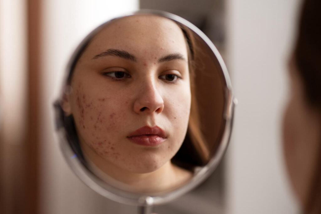 reflection of a sad woman because of acne