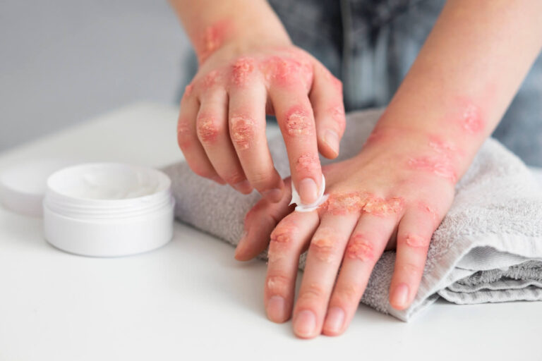 Visual Reference: Types Of Skin Disease Prevention Treatment Guide