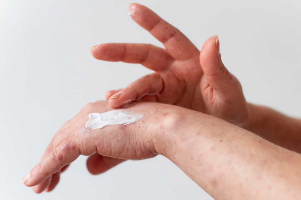 topical cream for managing atopic dermatitis