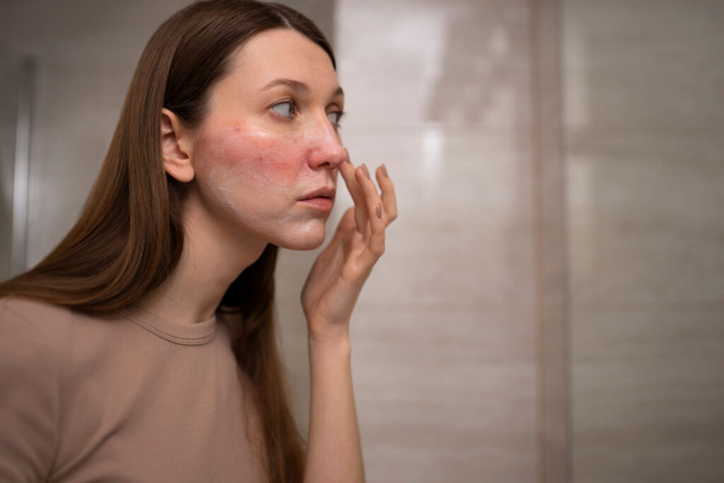 woman showing signs of rosacea - redness of skin