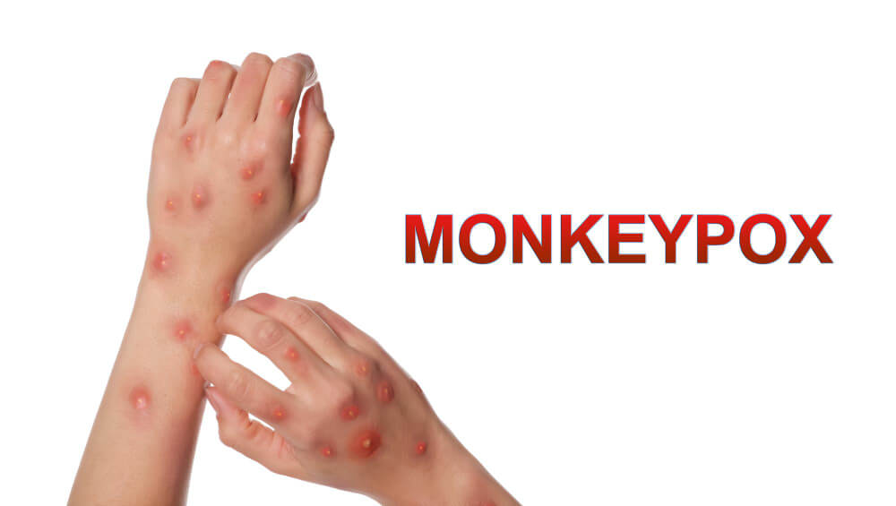 malaking pantal sa balat dahil sa Mpox