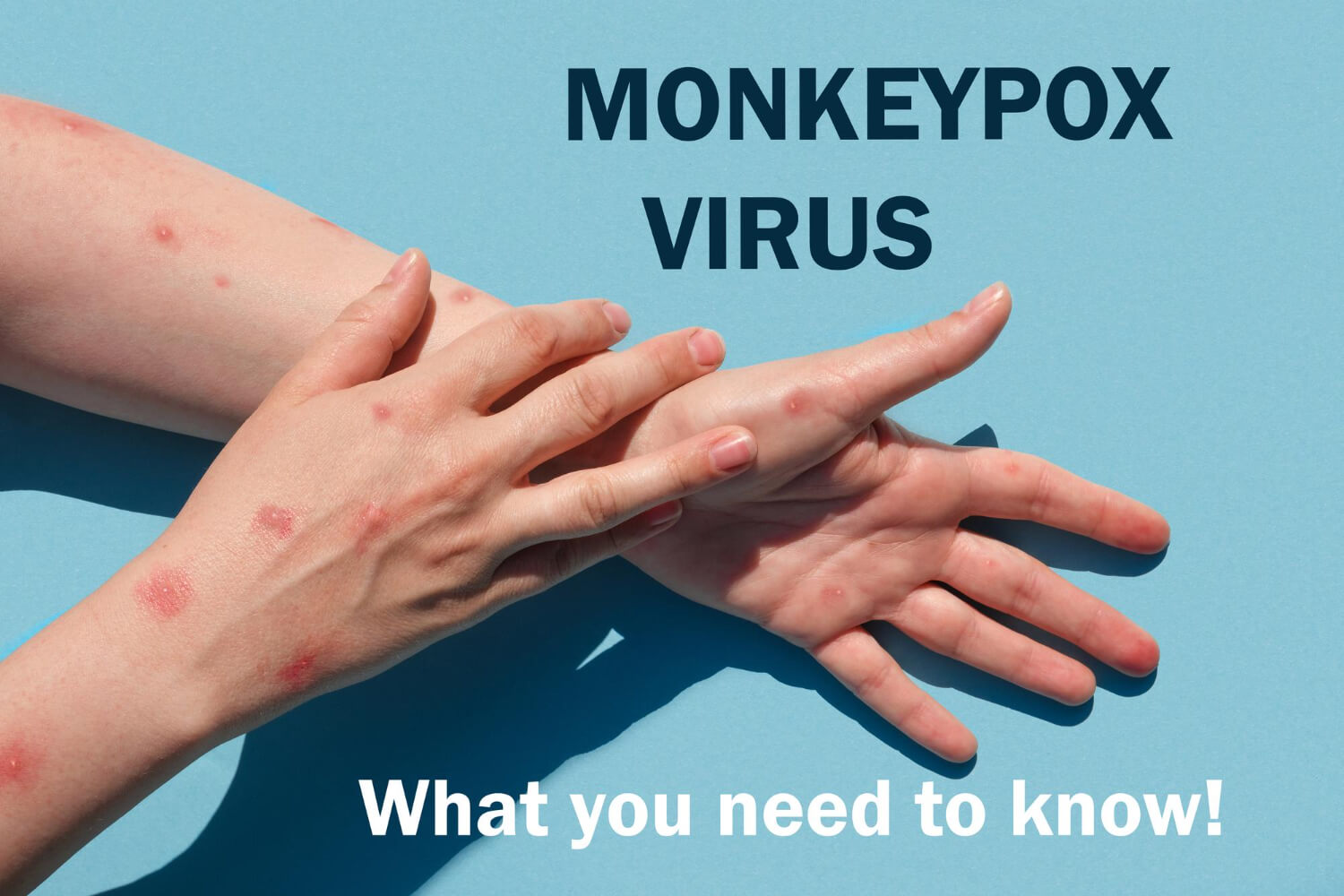 In-depth Mpox 101 Guide for Filipinos