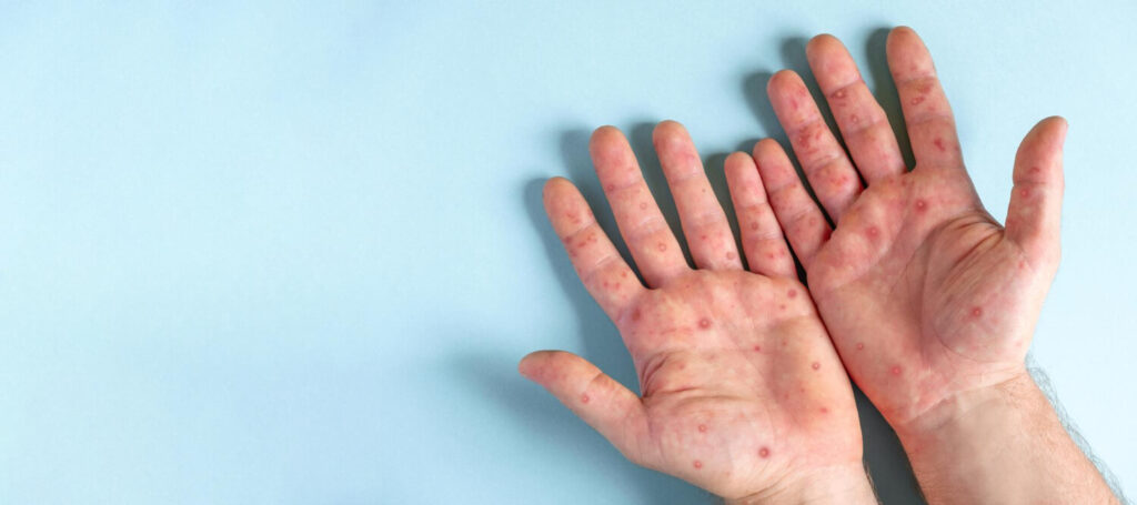 mpox symptoms - palms of the hands rashes