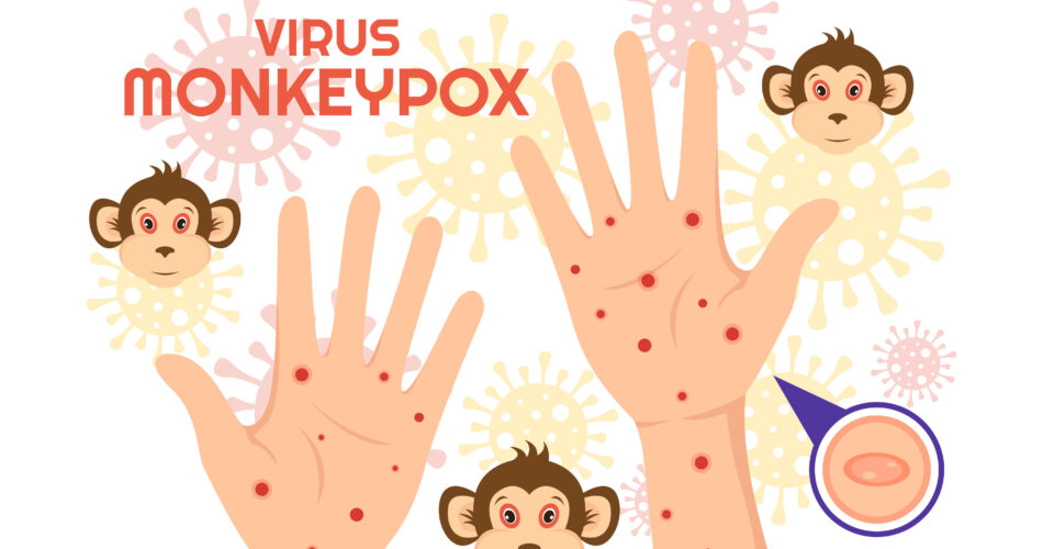 mpox risk factors