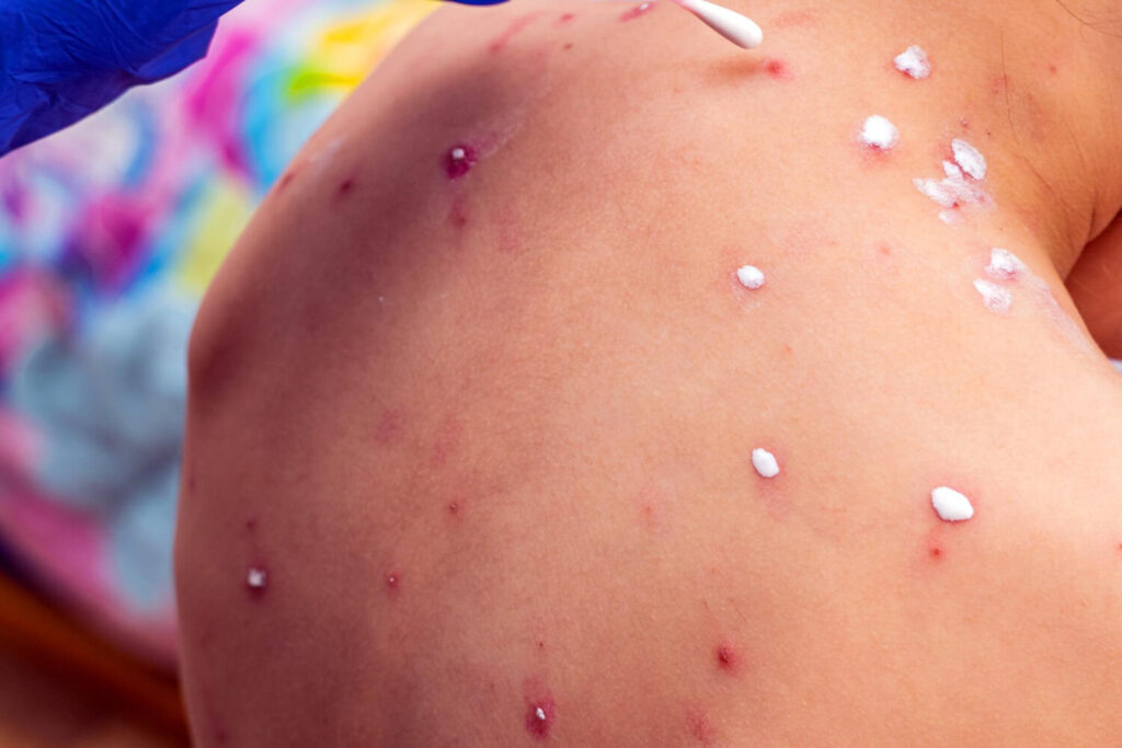 lunas sa mpox - upang maiwasan ang pagkalat ng paltos ng mpox