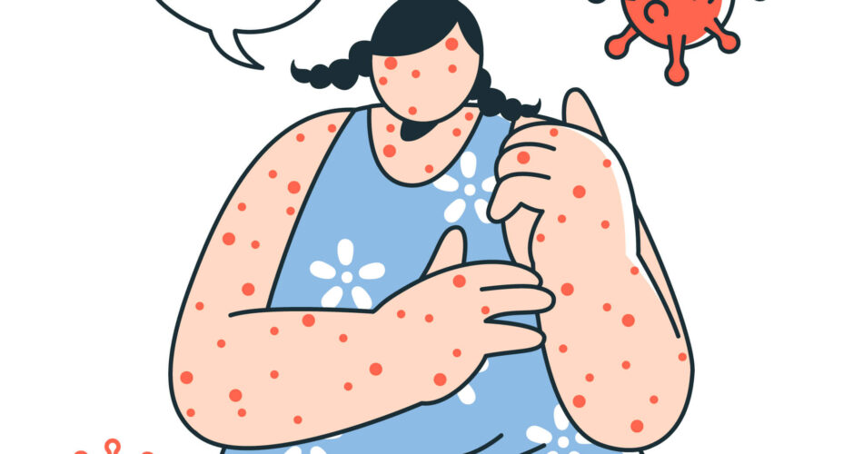 paano gamutin ang shingles