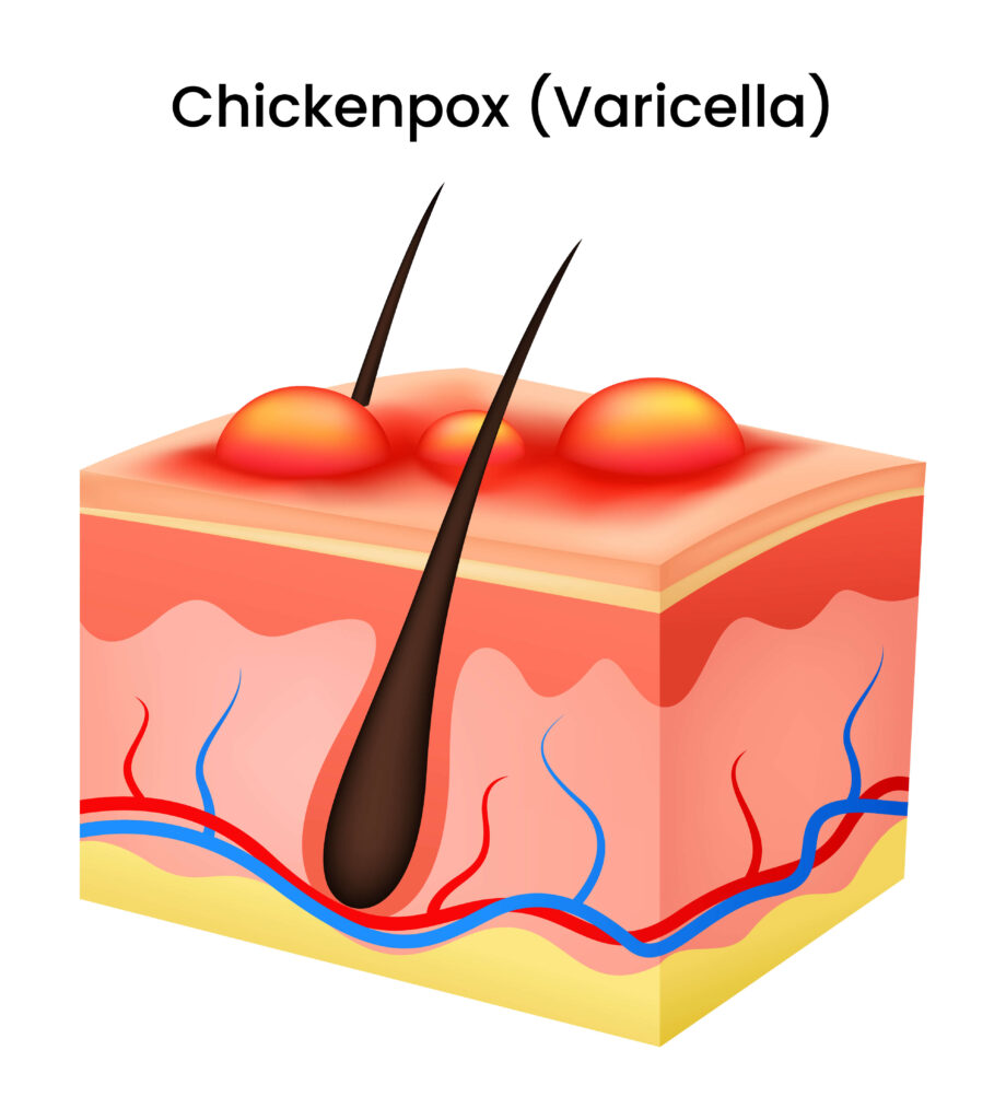 varicella zoster virus na nagdudulot ng chickenpox at shingles