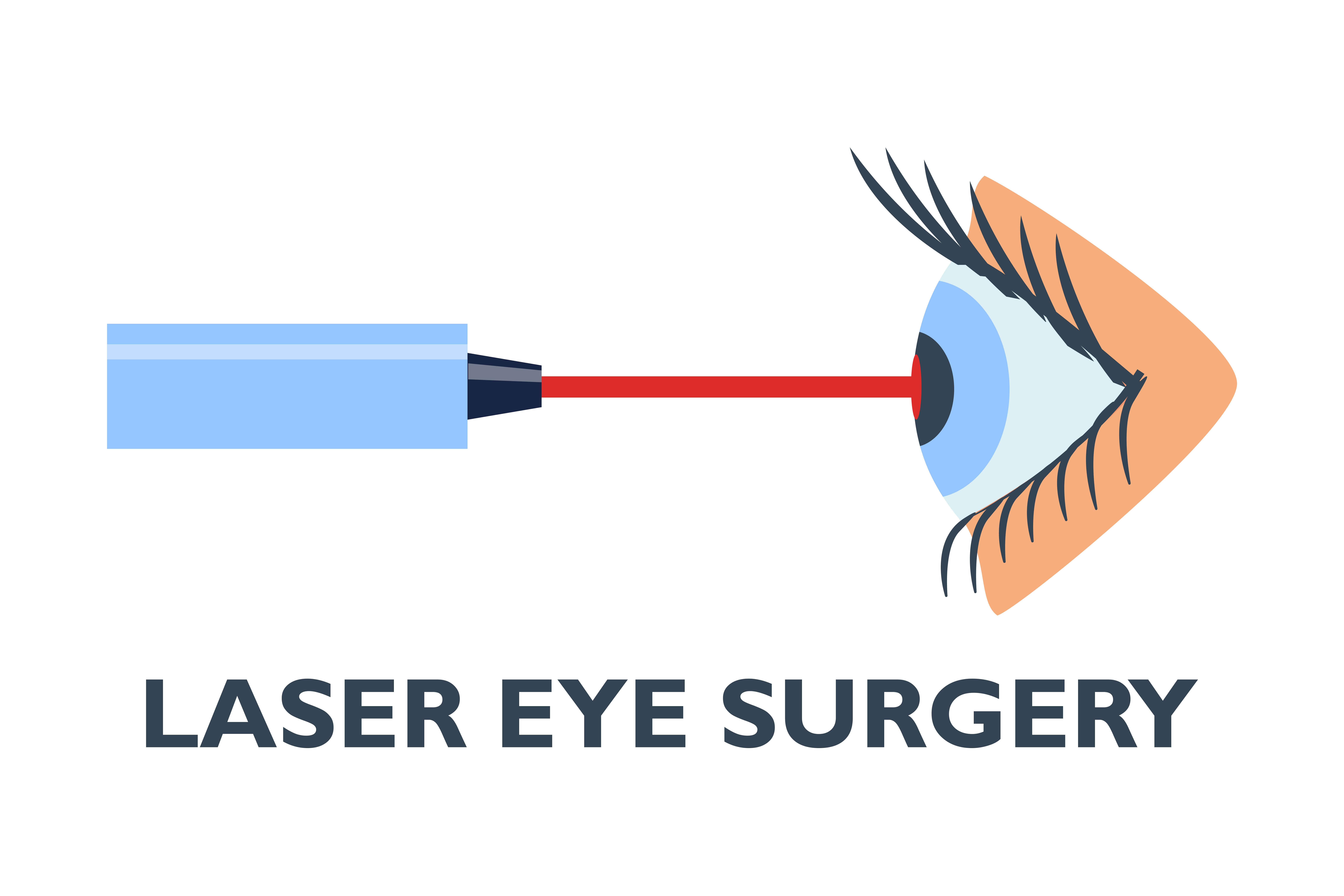 lasik eye surgery for nearsightedness