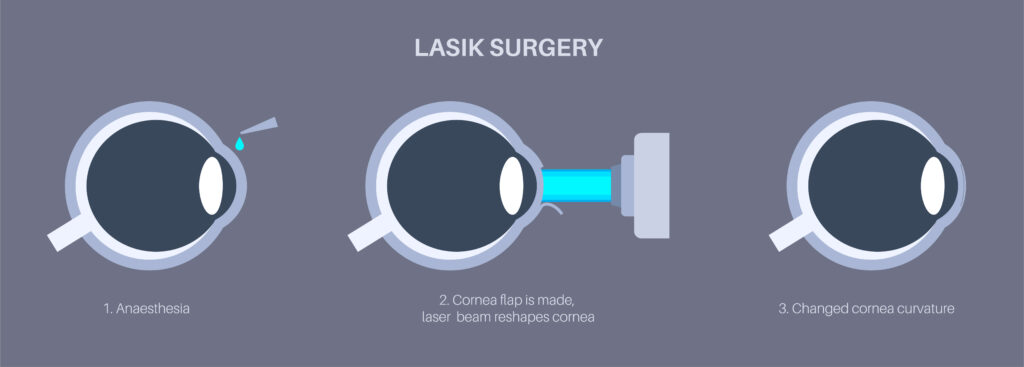 what is LASIK eye surgery