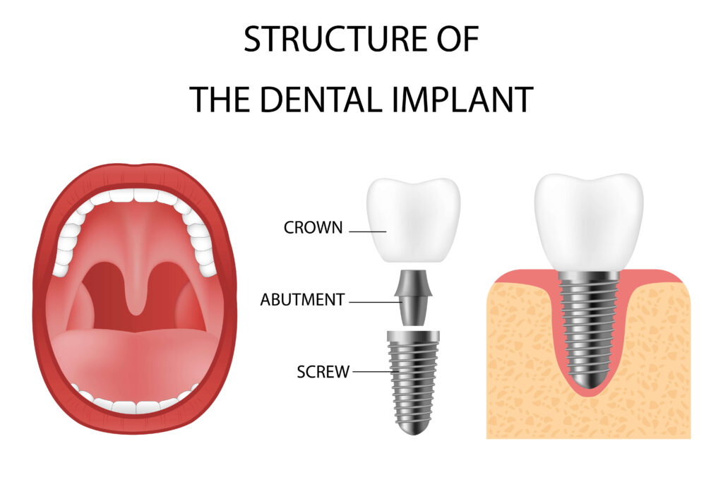dental implant procedure