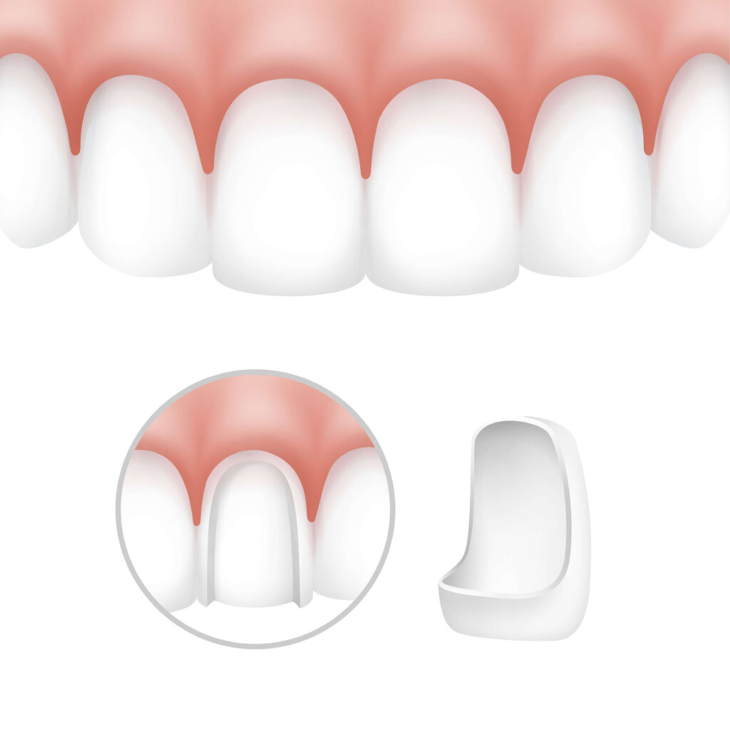 dental veneers - different types of veneers