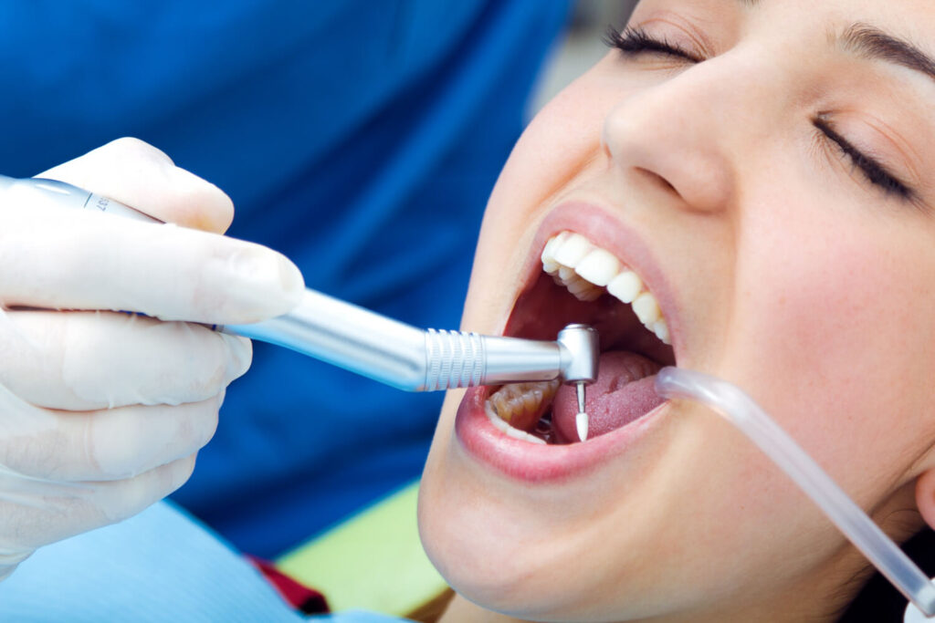 tartar removal - teeth cleaning
