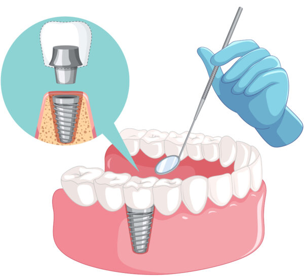 teeth implants price