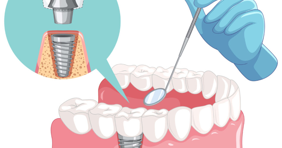 teeth implants price