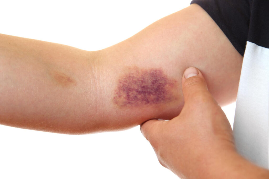 hemophilia patient with bruises