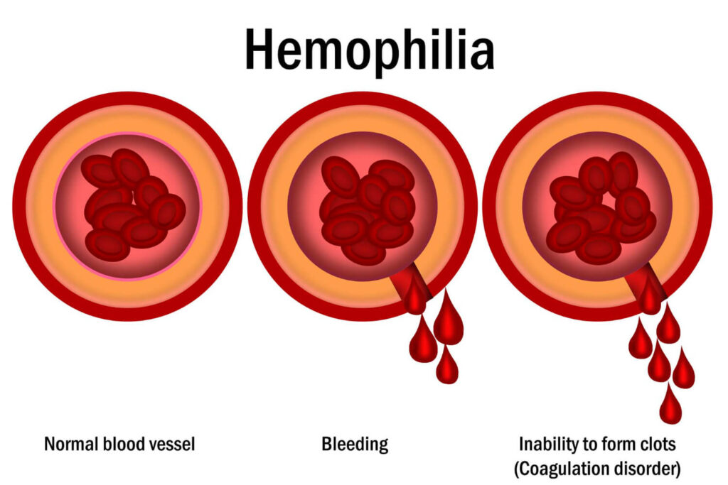 hemophilia what it means