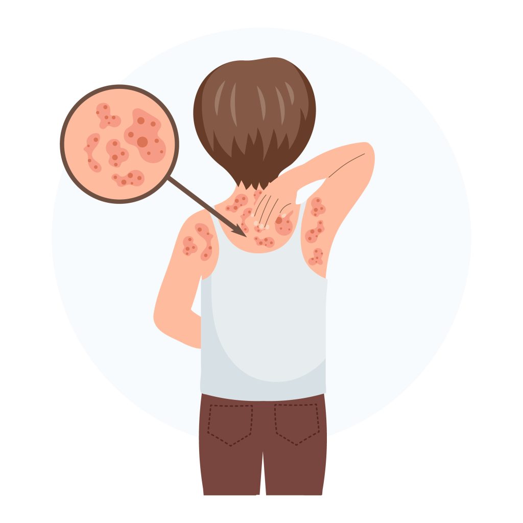 mumps, measles, and rubella german measles - MMR conditions