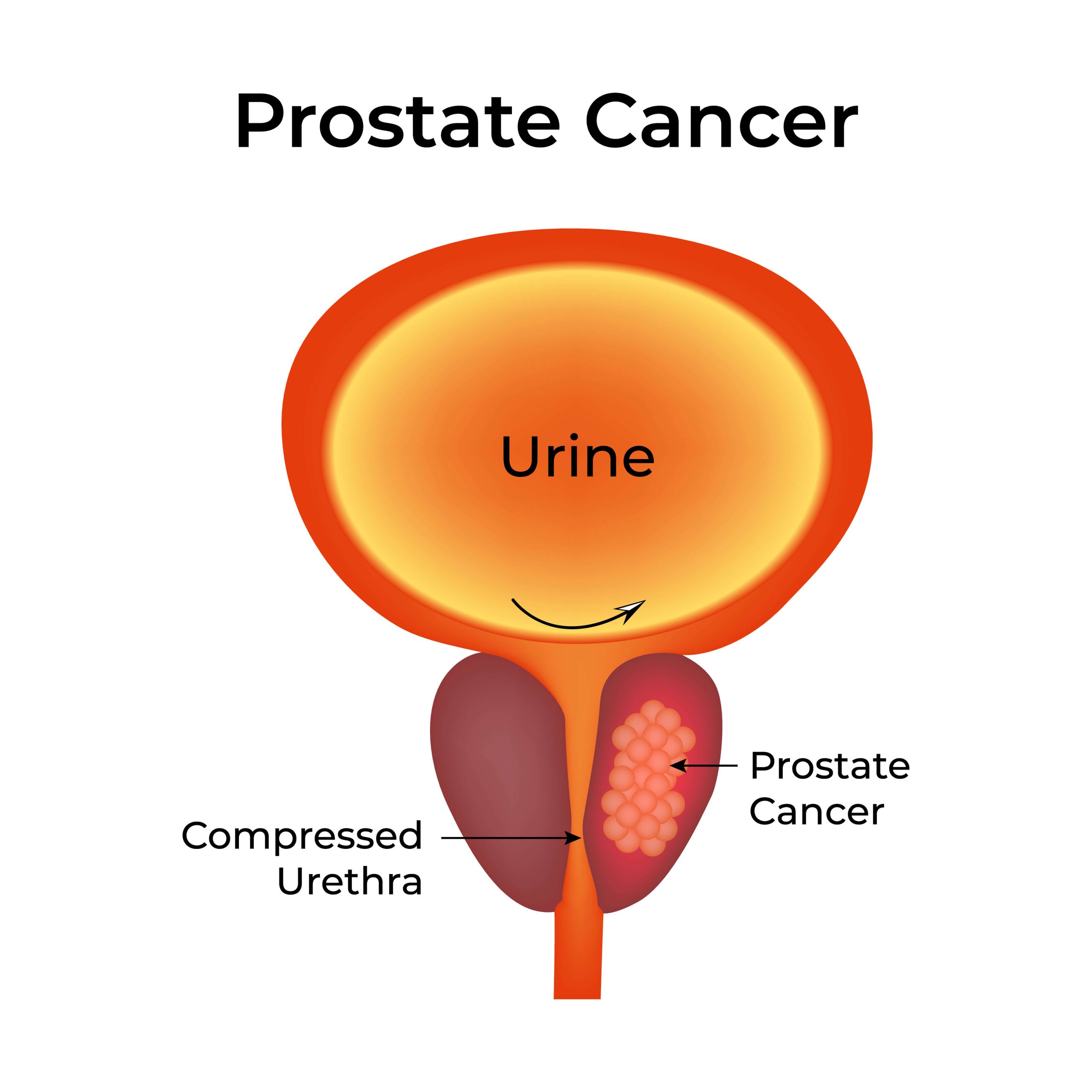 early signs of prostate cancer - urinary tract