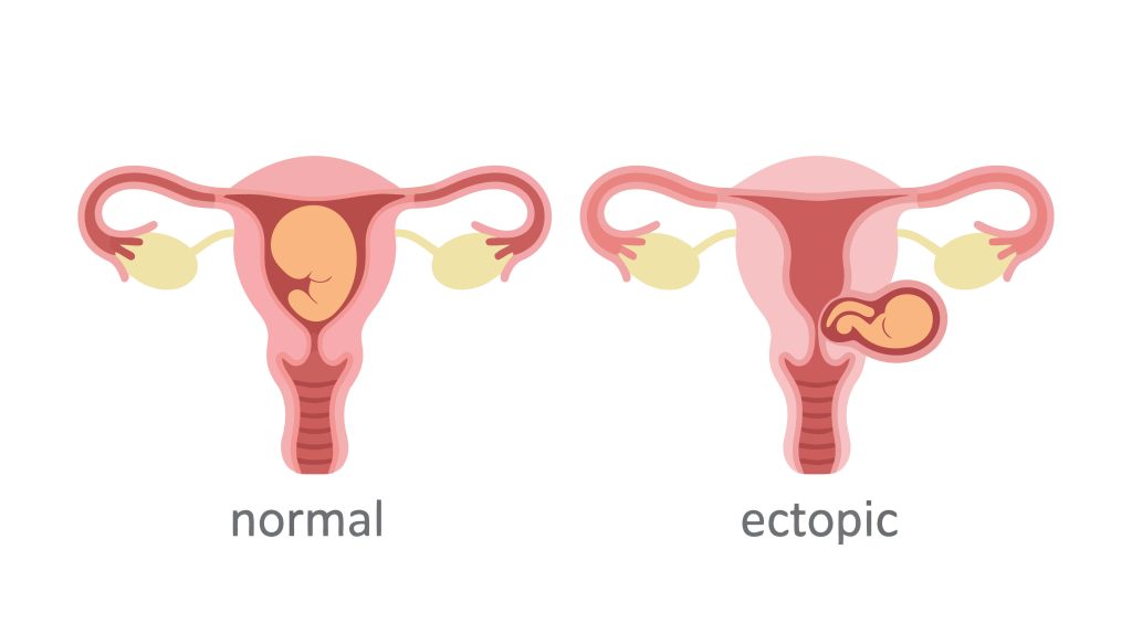 ectopic pregnancy