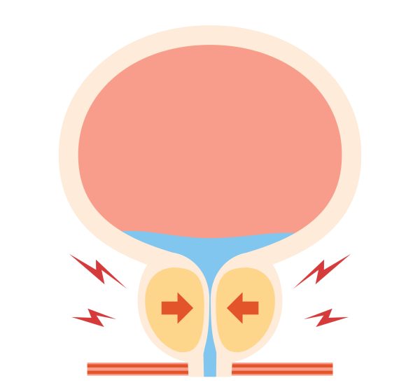 enlarged prostate treatment
