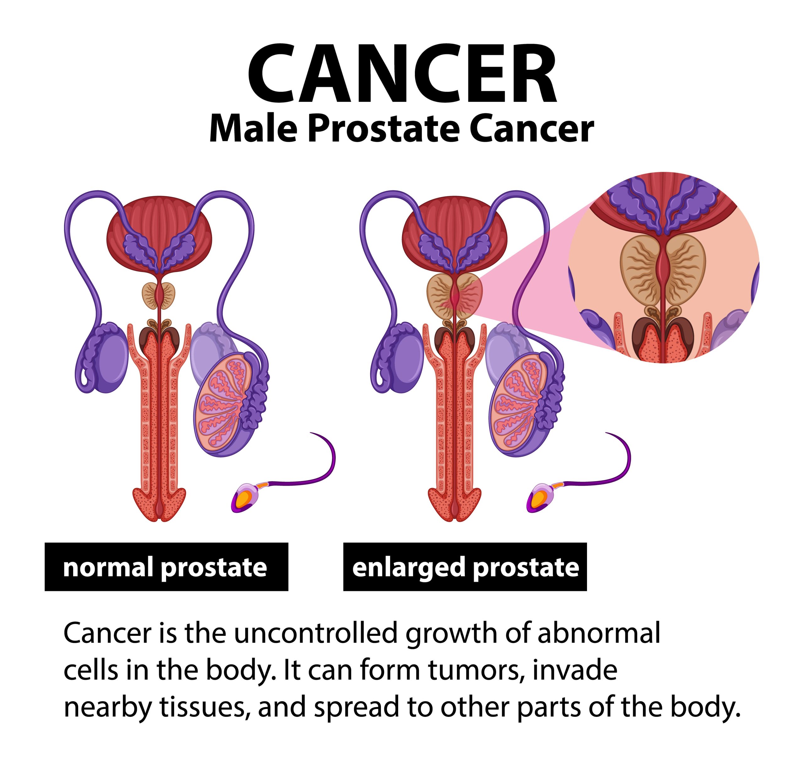 prostate cancer definition