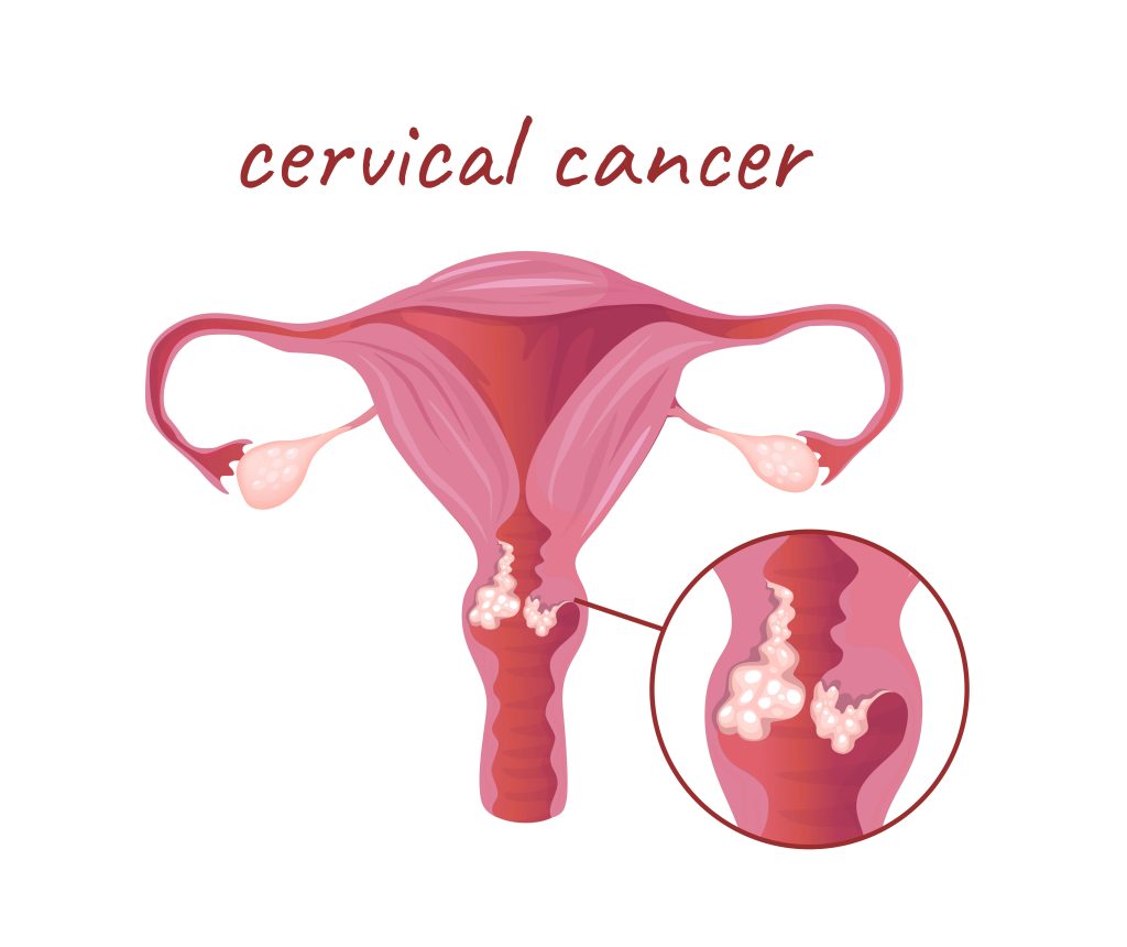 stages of cervical cancer