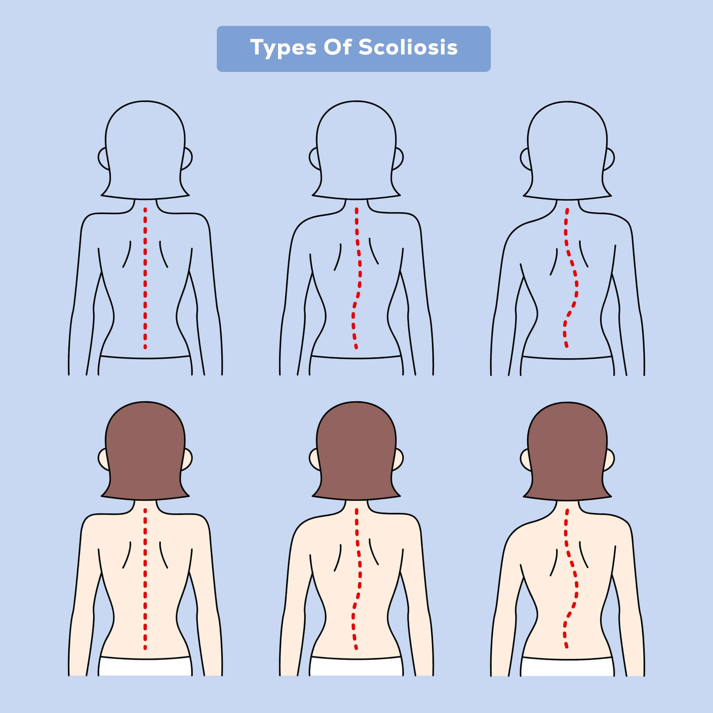 types of scoliosis