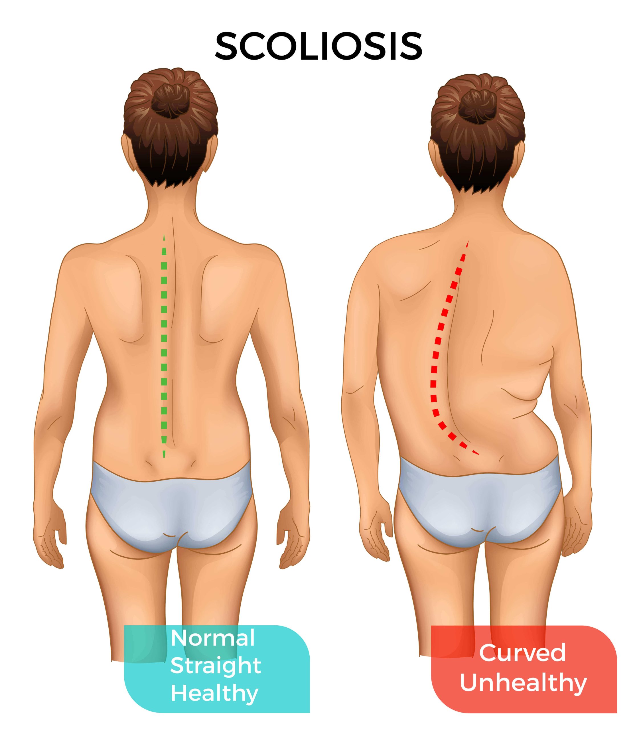 visual signs and symptoms of scoliosis